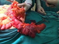 Bağırsak Ameliyatı Sonrası Enfeksiyon