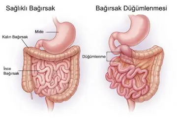 Bağırsak Düğümlenmesi Ameliyatı Riskleri ve Sonrası