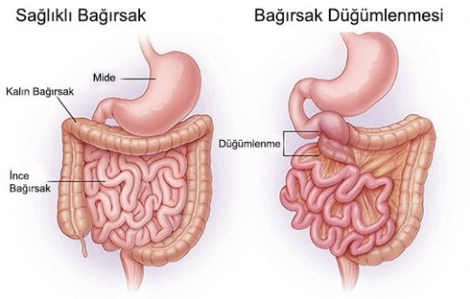İnce Bağırsak Tıkanıklığı Belirtileri ve Tedavisi